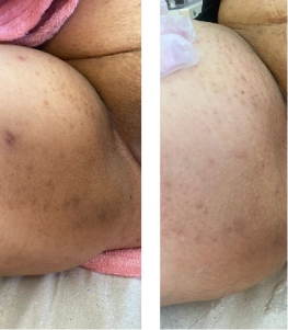 1-Antes-e-depois-botox-1-1-1.webp