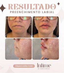 1-Antes-e-depois-botox-1-1.webp