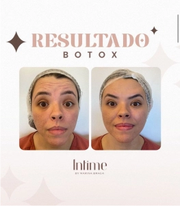 1-Antes-e-depois-botox-2.webp