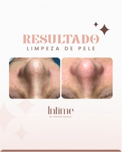 2-ANTES-E-DEPOIS-LIMPEZA-DE-PELE-1.webp